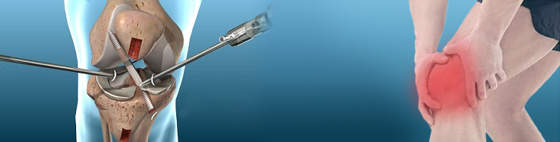 ACL Reconstruction